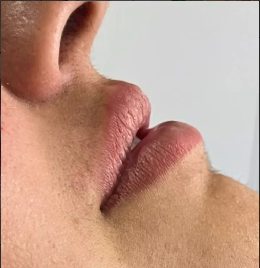 Antes da harmonização facial