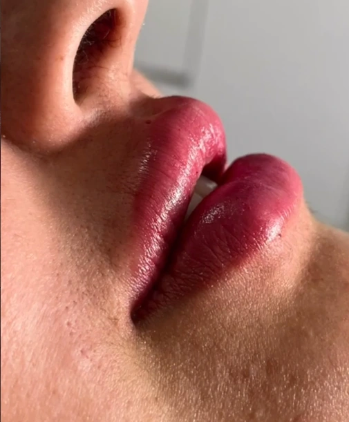 Depois da harmonização facial